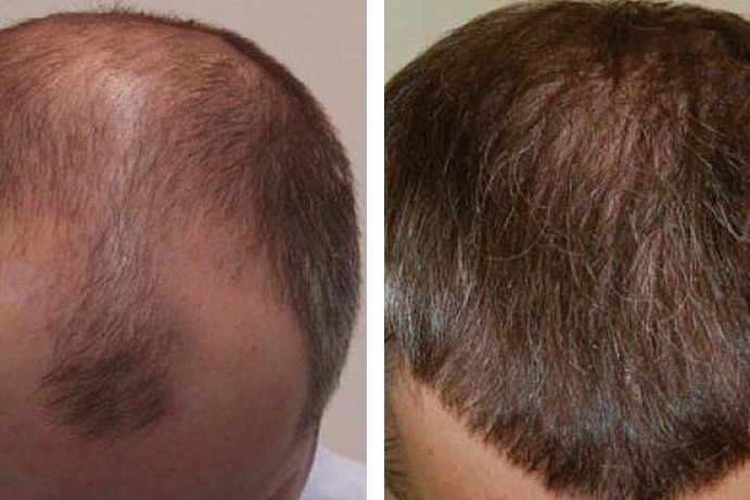 Hair Transplant After Before