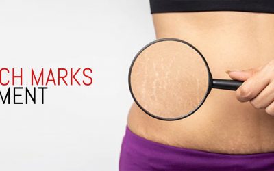 Stretch Marks: Causes, Treatment – LARC