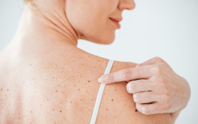 Skin Pigmentation: Cause, Symptoms, Treatment