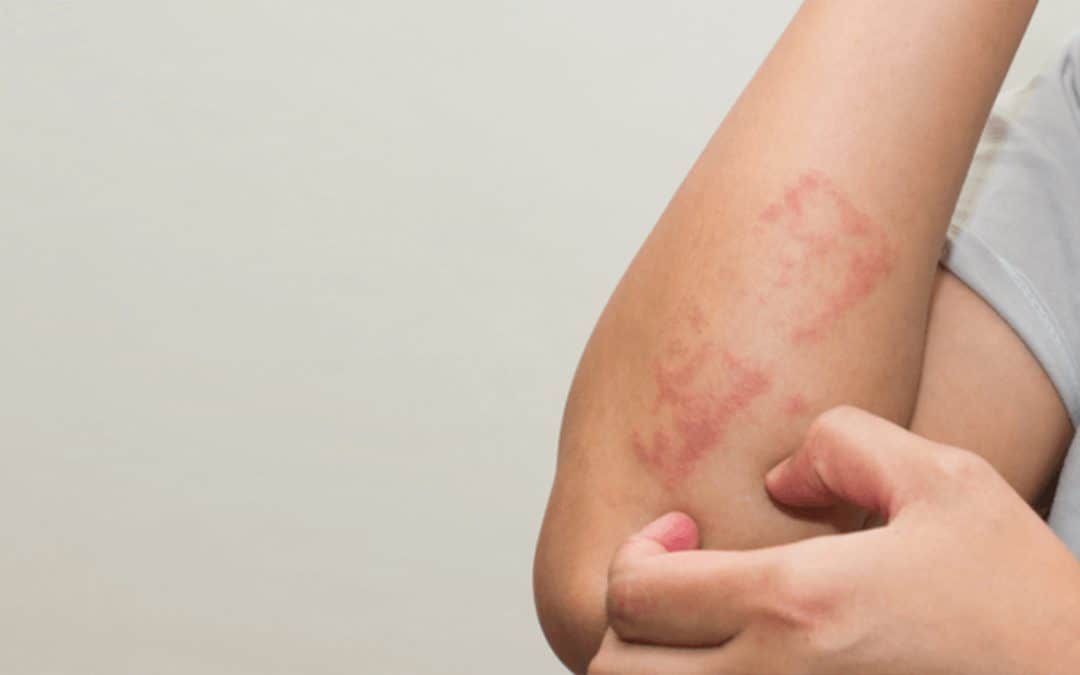 Eczema--1080x675