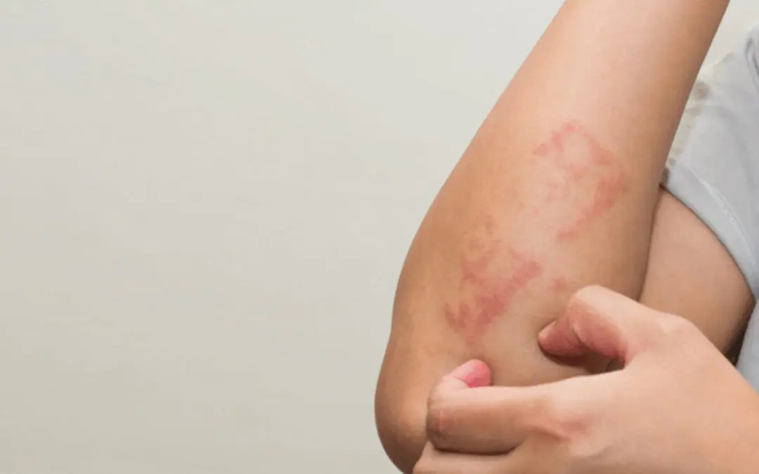 Eczema: Causes, Types, Treatment