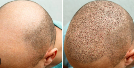 A Comprehensive Guide to Hair Transplant Treatment in Pakistan