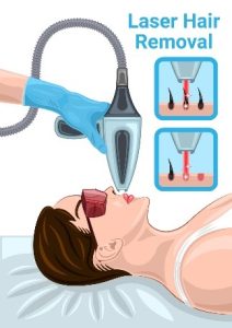 laser hair removal