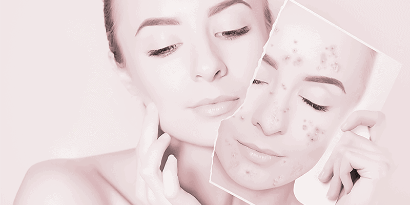 acne scar treatment