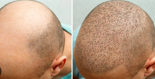 hair transplant