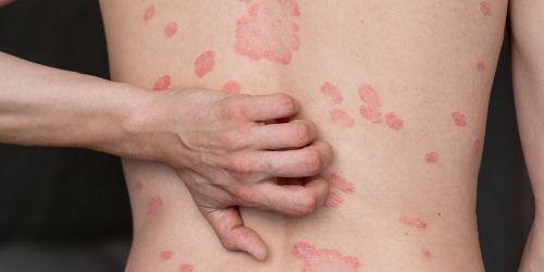 Psoriasis treatment
