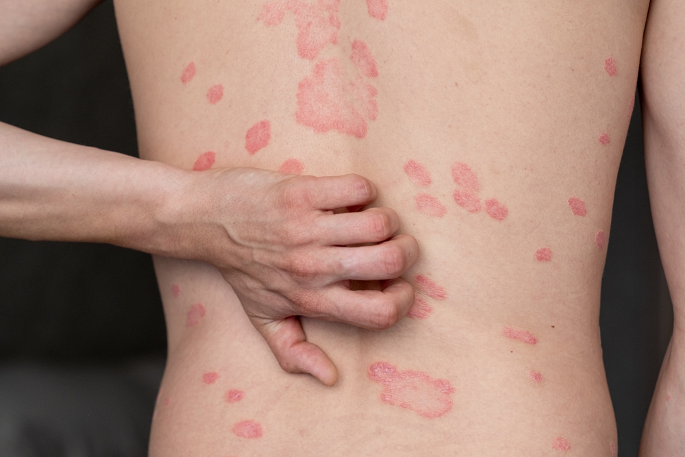 Psoriasis treatment