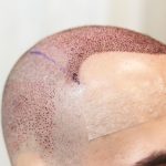 hair transplant