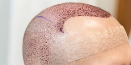 hair transplant