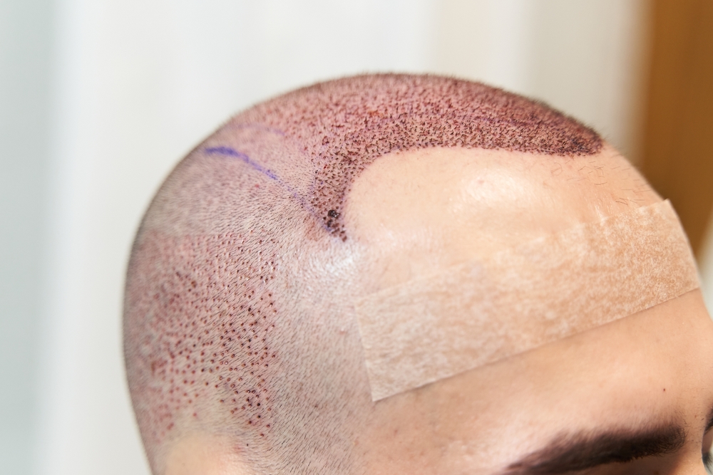 hair transplant