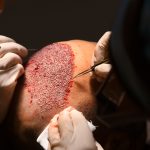 Hair transplant in lahore