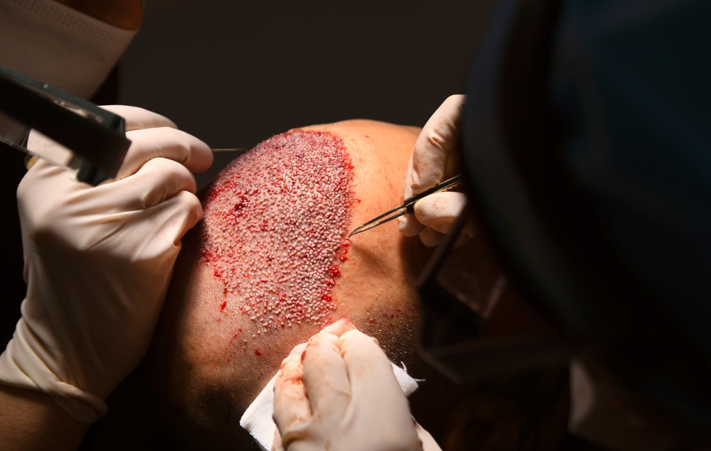 Hair transplant in lahore