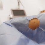 mole removal treatment