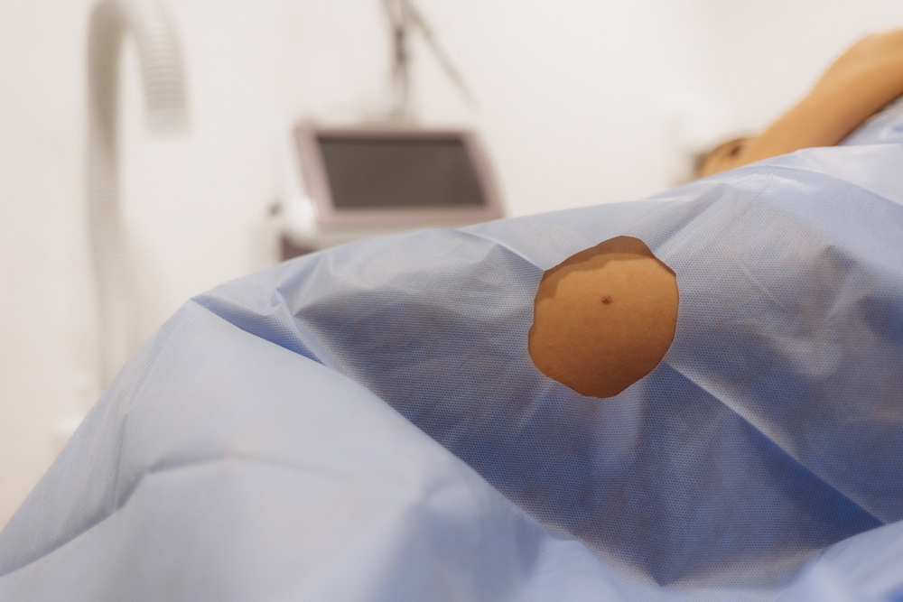 mole removal treatment