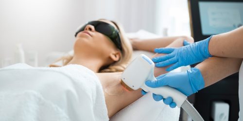 laser hair removal