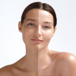 skin whitening treatment