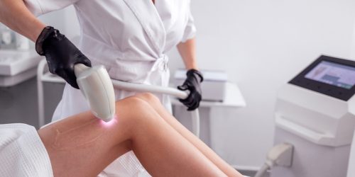 laser hair removal