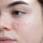 Acne treatment in lahore