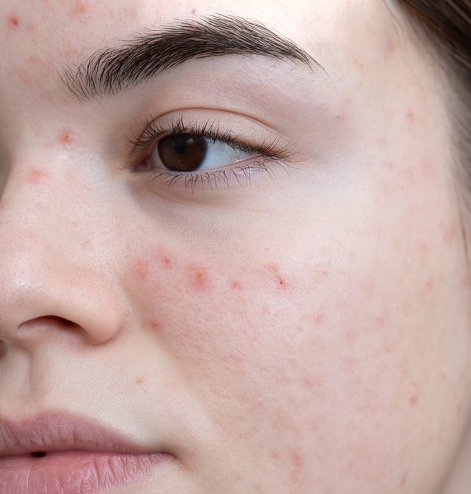 Acne treatment in lahore