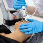 acne scars treatment