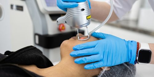 acne scars treatment