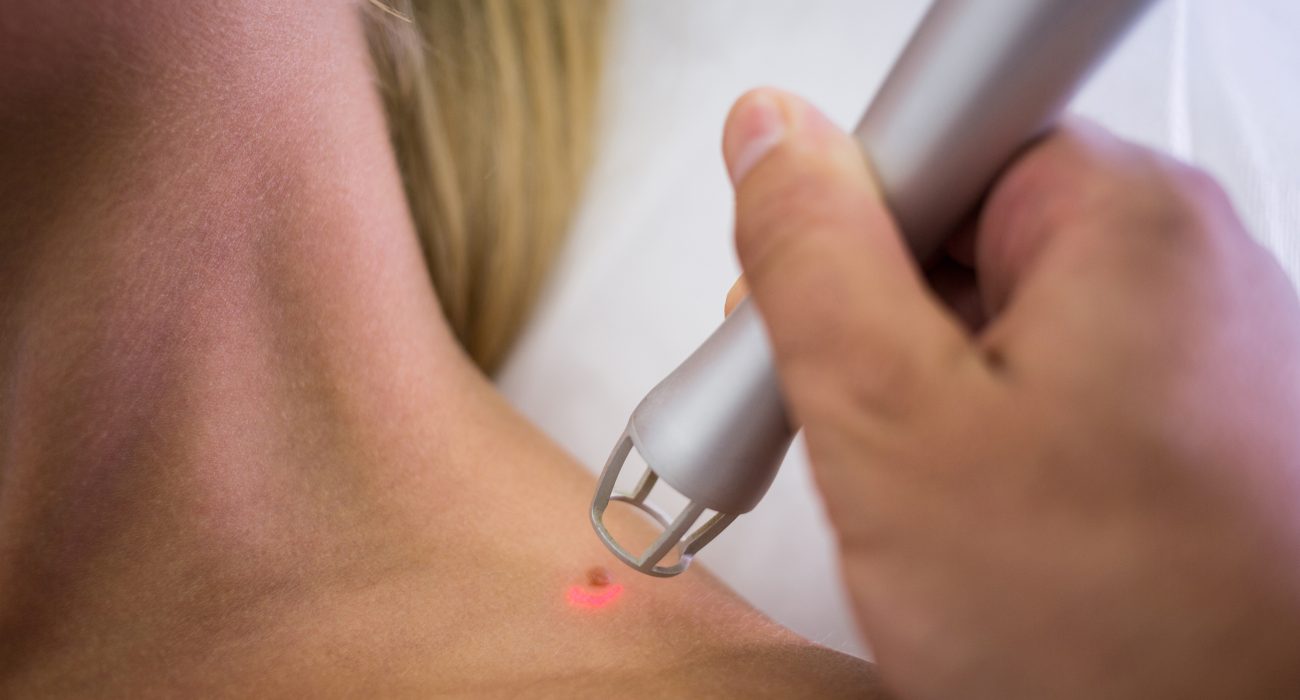 mole removal treatment in lahore