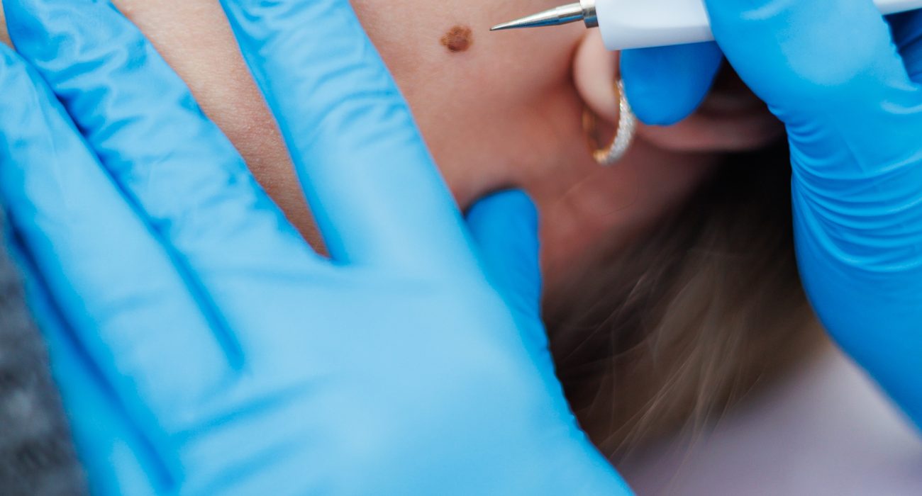 mole removal treatment in lahore