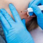 mole removal treatment in lahore