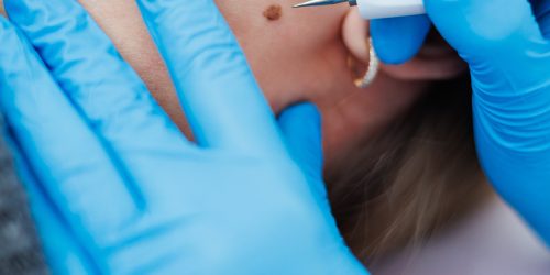 mole removal treatment in lahore